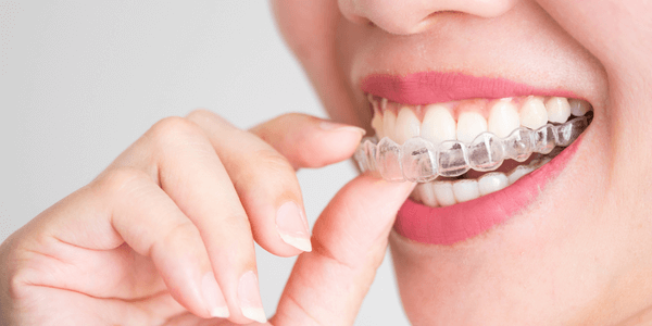 How To Get Straight Teeth - Your Complete Guide - Ewell Orthodontics